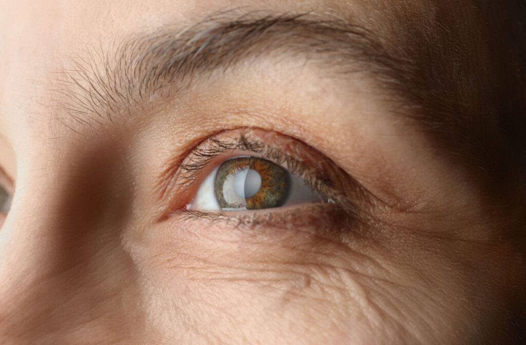 Close-up of an eye with a visible cataract.