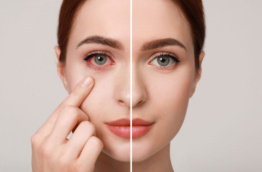 A close-up of a person's face showing pink eye on one side and a healthy eye on the other.
